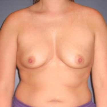 Dual-plane technique Before Patient 12