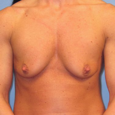 Dual-plane technique Before Patient 20