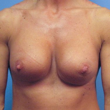 Dual-plane technique After Patient 20