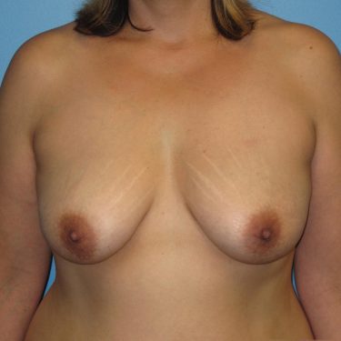 Breast Lift Before Patient 12