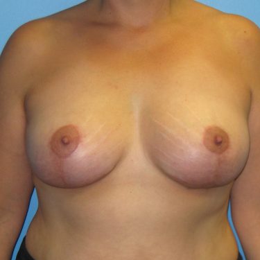 Breast Lift After Patient 12