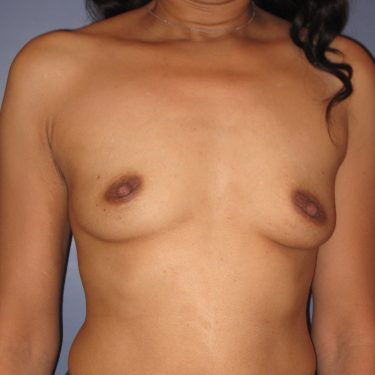 Breast Augmentation Before Patient 22