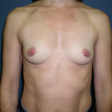 Breast Augmentation Before Patient 21