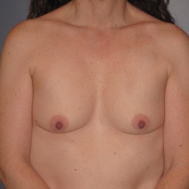 Dual-plane technique Before Patient 19