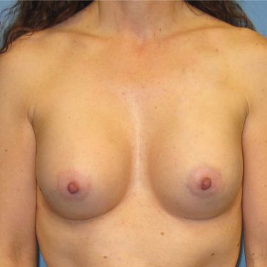 Dual-plane technique After Patient 19