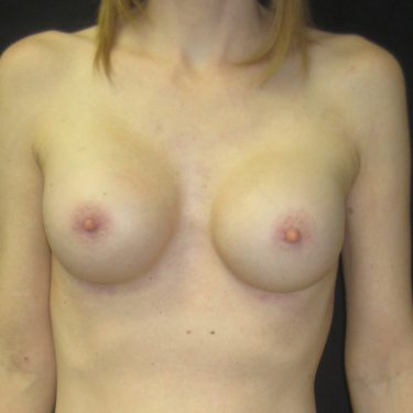 Breast Augmentation After Patient 18