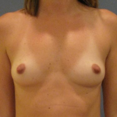 Breast Augmentation Before Patient 17