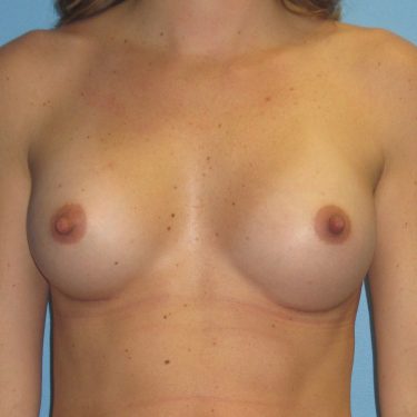 Breast Augmentation After Patient 17