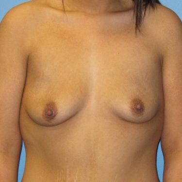 Dual-plane technique Before Patient 17