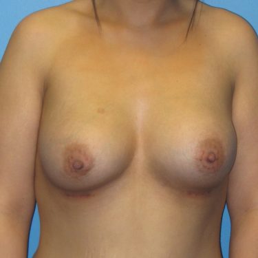 Dual-plane technique After Patient 17