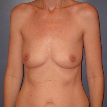 Breast Augmentation Before Patient 14