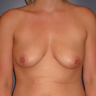 Breast Lift Before Patient 11