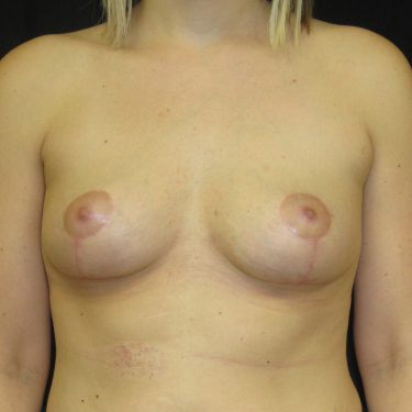 Breast Lift After Patient 11