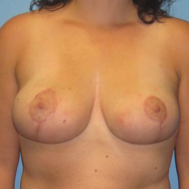 Breast Lift After Patient 10