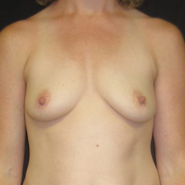 Dual-plane technique Before Patient 16