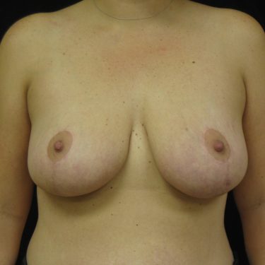 Breast Lift After Patient 9