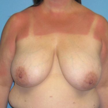 Breast Reduction Before Patient 11