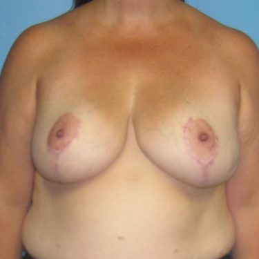 Breast Reduction After Patient 11