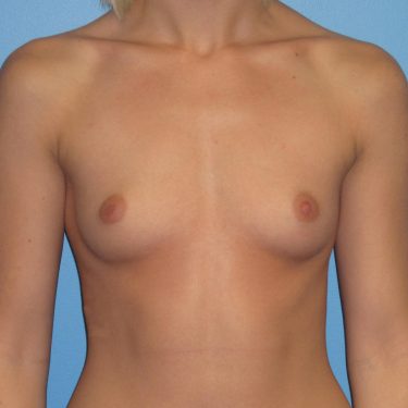 Breast Augmentation Before Patient 12