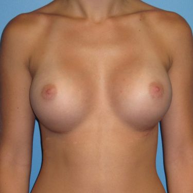 Breast Augmentation After Patient 12