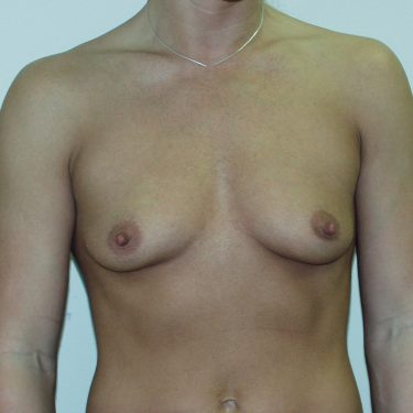 Breast Augmentation Before Patient 11