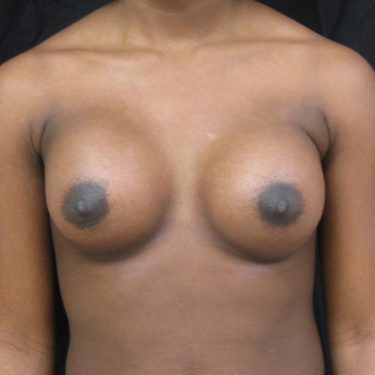 Breast Augmentation After Patient 10