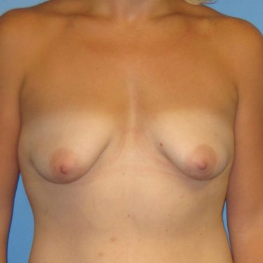 Breast Lift Before Patient 8