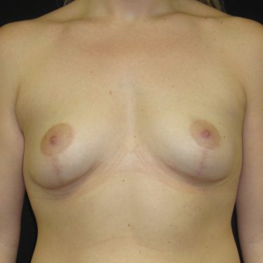 Breast Lift After Patient 8