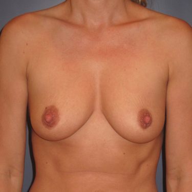 Breast Augmentation Before Patient 9