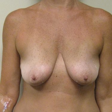 Breast Augmentation & Lift Before Patient 8