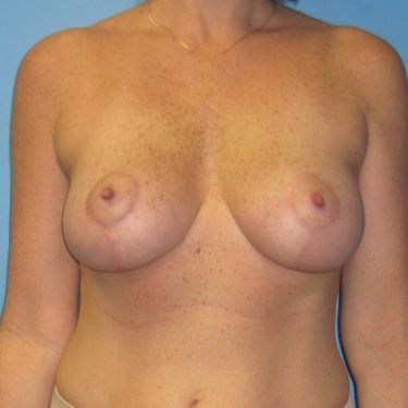 Breast Augmentation with Lift After Patient 8