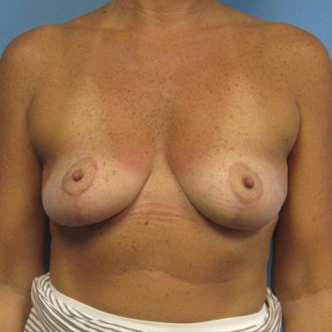 Breast Lift After Patient 6