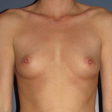 Breast Augmentation Before Patient 7