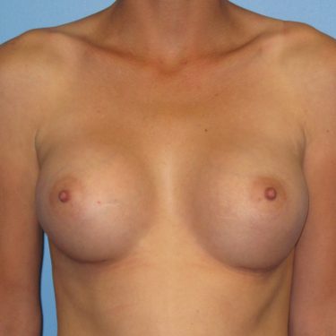 Breast Augmentation After Patient 7