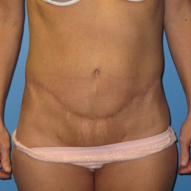 Surgery After Weight Loss After Patient 22