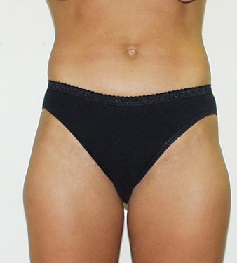 Liposuction After Patient 4