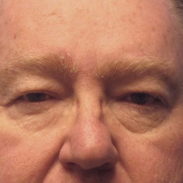 Eyes & Brow Before Patient 16