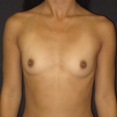 Breast Augmentation Before Patient 6