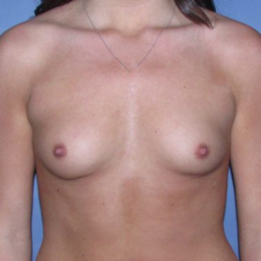 Breast Augmentation Before Patient 5
