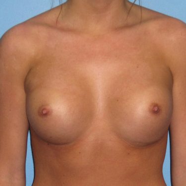 Breast Augmentation After Patient 5