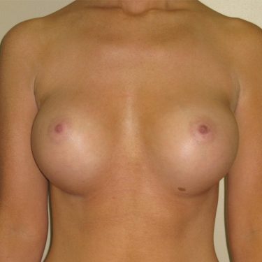 Breast Augmentation After Patient 3