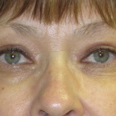 Eyes & Brow After Patient 8