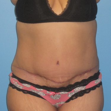 Surgery After Weight Loss After Patient 21