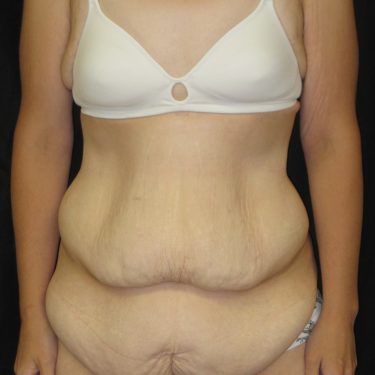 Tummy Tuck Before Patient 30