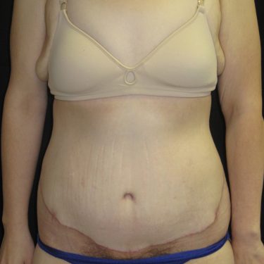 Tummy Tuck After Patient 30