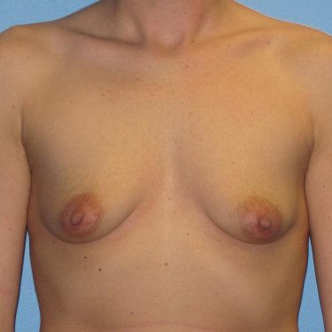 Dual-plane technique Before Patient 15