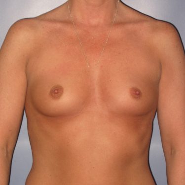 Breast Augmentation Before Patient 5