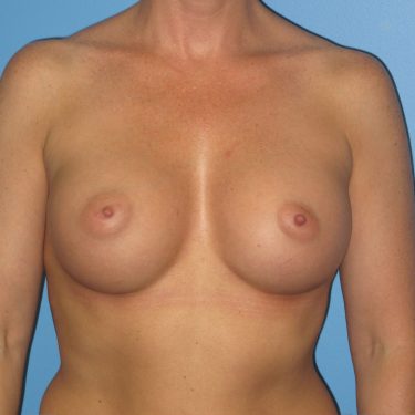 Breast Augmentation After Patient 5