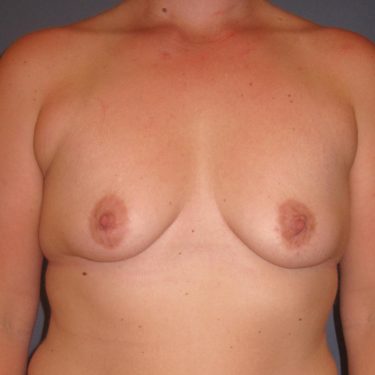 Subglandular Before Patient 10