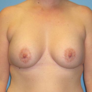 Subglandular After Patient 10